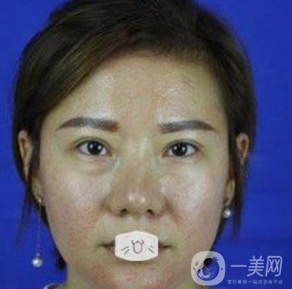 綿陽(yáng)中心醫(yī)院整形美容科價(jià)格表2020發(fā)布，附祛眼袋案例