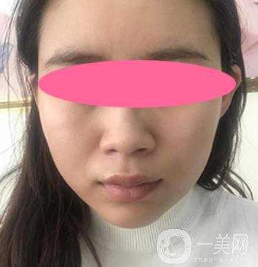 寧波第一醫(yī)院整形科價格表收費明細上線，看打玻尿酸真人案例