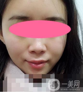 寧波第一醫(yī)院整形科價格表收費明細上線，看打玻尿酸真人案例