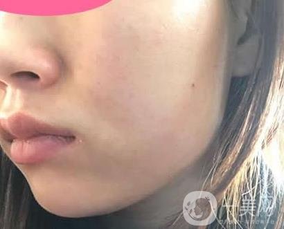 寧波第一醫(yī)院整形科價格表收費明細上線，看打玻尿酸真人案例