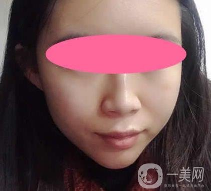 寧波第一醫(yī)院整形科價格表收費明細上線，看打玻尿酸真人案例