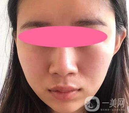 寧波第一醫(yī)院整形科價格表收費明細上線，看打玻尿酸真人案例