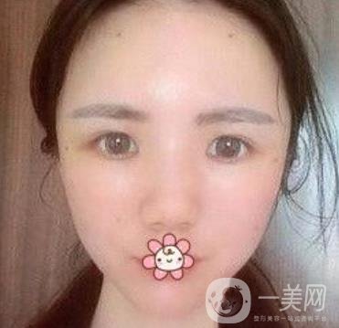 上海第九人民醫(yī)院整形外科價(jià)格表，附面部脂肪填充案例