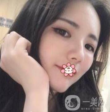 上海第九人民醫(yī)院整形外科價(jià)格表，附面部脂肪填充案例