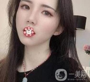 上海第九人民醫(yī)院整形外科價(jià)格表，附面部脂肪填充案例