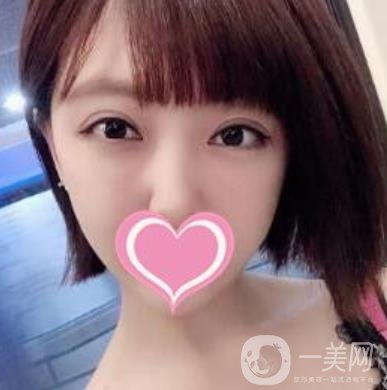 上海第一醫(yī)院整形外科價(jià)格表明細(xì)及割雙眼皮日記分享