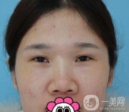 2020北京大學(xué)深圳醫(yī)院整形科價(jià)格表，附雙眼皮案例