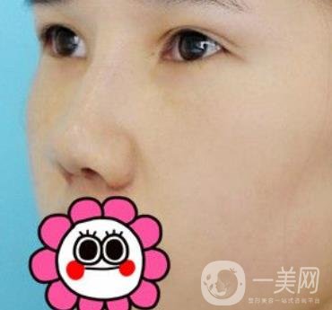 2020北京大學(xué)深圳醫(yī)院整形科價(jià)格表，附雙眼皮案例