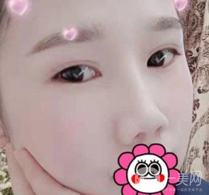 2020北京大學(xué)深圳醫(yī)院整形科價(jià)格表，附雙眼皮案例
