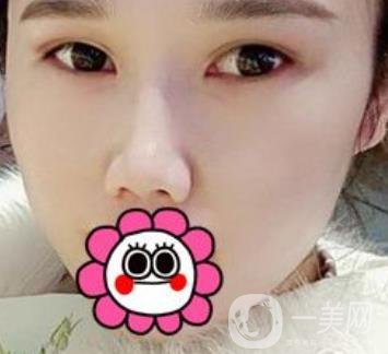 2020北京大學(xué)深圳醫(yī)院整形科價(jià)格表，附雙眼皮案例