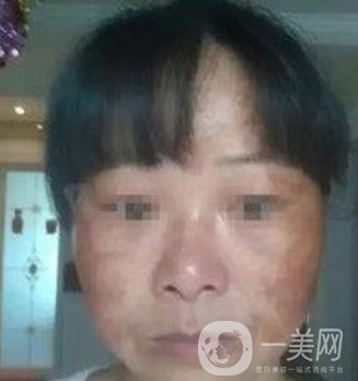 廣東省人民醫(yī)院整形科價格表，附祛斑整形日記