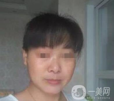 廣東省人民醫(yī)院整形科價格表，附祛斑整形日記