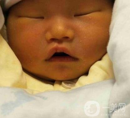 昆明醫(yī)科大學第一附屬醫(yī)院整形科價格表，內(nèi)附兔唇矯正案例