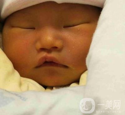 昆明醫(yī)科大學第一附屬醫(yī)院整形科價格表，內(nèi)附兔唇矯正案例