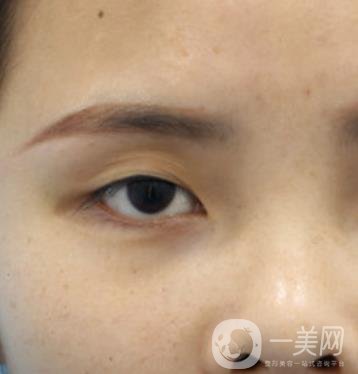 西安交通大學附屬醫(yī)院整形美容科價格表和雙眼皮案例一覽