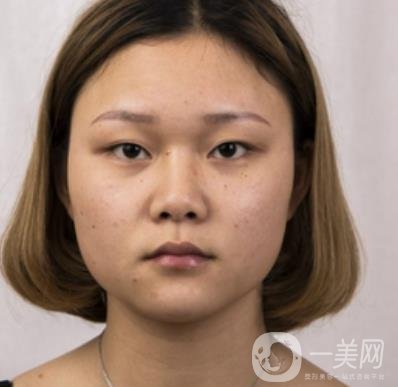 西安市中心醫(yī)院整形科價格表，內(nèi)附韓悅雙眼皮真人案例