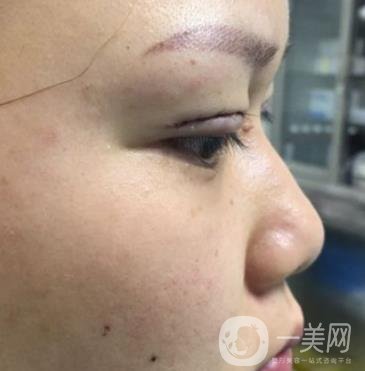 西安市中心醫(yī)院整形科價格表，內(nèi)附韓悅雙眼皮真人案例