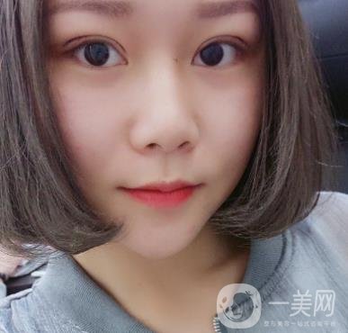 西安市中心醫(yī)院整形科價格表，內(nèi)附韓悅雙眼皮真人案例