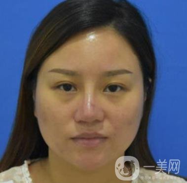 張掖市人民醫(yī)院美容整形科價(jià)格表，附眼袋切除*果圖