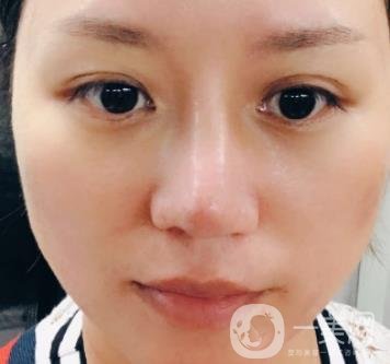 張掖市人民醫(yī)院美容整形科價(jià)格表，附眼袋切除*果圖