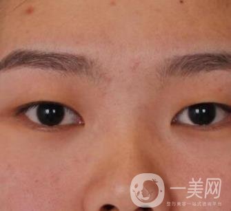 北京醫(yī)院整形項(xiàng)目2020年價(jià)格表一覽，內(nèi)附錢文江開眼角案例