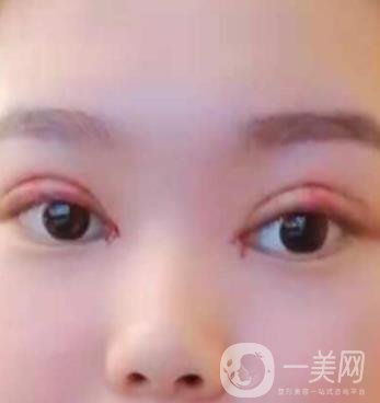 北京醫(yī)院整形項(xiàng)目2020年價(jià)格表一覽，內(nèi)附錢文江開眼角案例