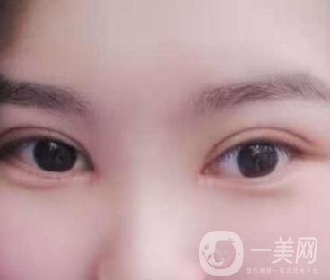 北京醫(yī)院整形項(xiàng)目2020年價(jià)格表一覽，內(nèi)附錢文江開眼角案例