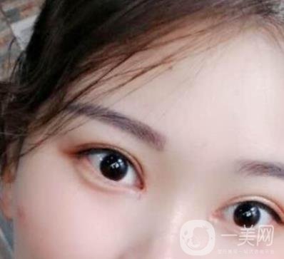 北京醫(yī)院整形項(xiàng)目2020年價(jià)格表一覽，內(nèi)附錢文江開眼角案例