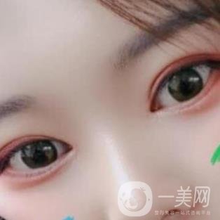 北京醫(yī)院整形項(xiàng)目2020年價(jià)格表一覽，內(nèi)附錢文江開眼角案例