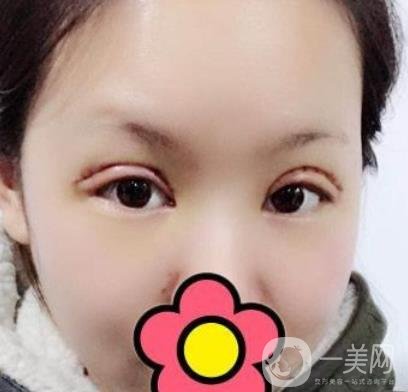 甘肅省人民醫(yī)院割雙眼皮怎么樣？附整形價格表及真人案例