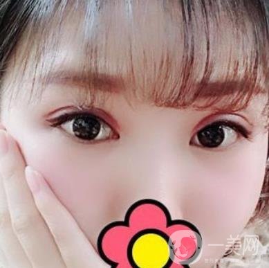 甘肅省人民醫(yī)院割雙眼皮怎么樣？附整形價格表及真人案例