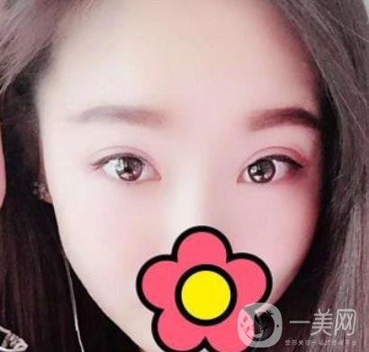 甘肅省人民醫(yī)院割雙眼皮怎么樣？附整形價格表及真人案例