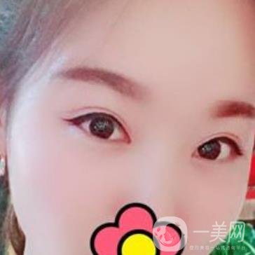 甘肅省人民醫(yī)院割雙眼皮怎么樣？附整形價格表及真人案例