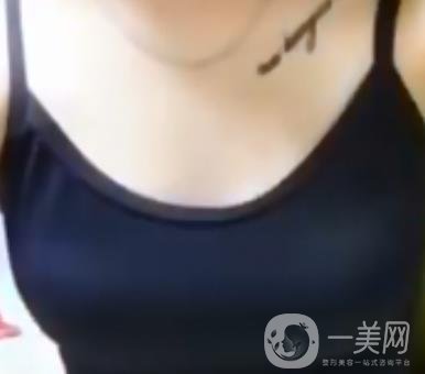 廣東省第二人民醫(yī)院隆胸手術(shù)多少錢？羅盛康案例？附整形價(jià)格表