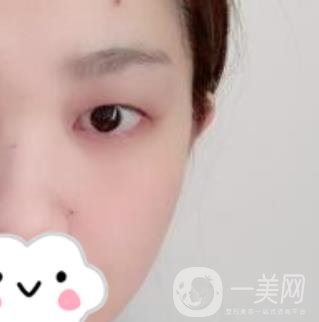 湖南省人民醫(yī)院割雙眼皮要多少錢？整形價(jià)格表一覽