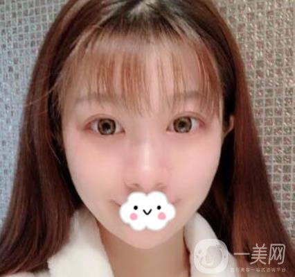 湖南省人民醫(yī)院割雙眼皮要多少錢？整形價(jià)格表一覽