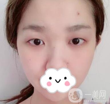 湖南省人民醫(yī)院割雙眼皮要多少錢？整形價(jià)格表一覽