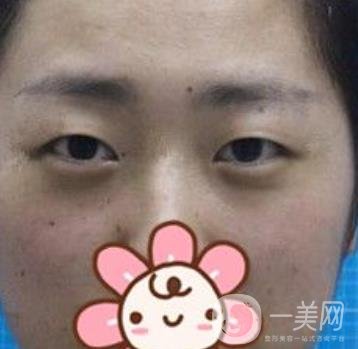 秦皇島人民醫(yī)院雙眼皮怎么樣？附整形價(jià)格表及案例圖
