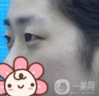 秦皇島人民醫(yī)院雙眼皮怎么樣？附整形價(jià)格表及案例圖