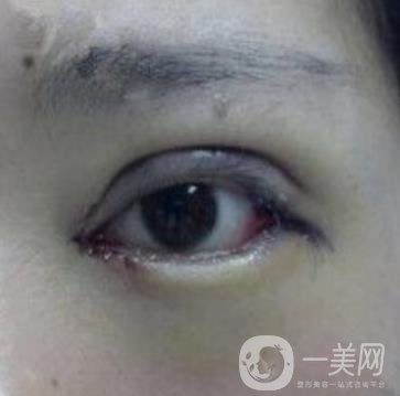 秦皇島人民醫(yī)院雙眼皮怎么樣？附整形價(jià)格表及案例圖