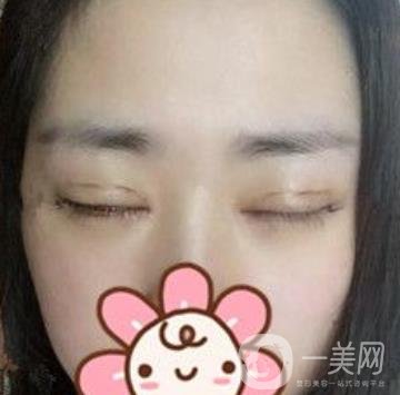 秦皇島人民醫(yī)院雙眼皮怎么樣？附整形價(jià)格表及案例圖