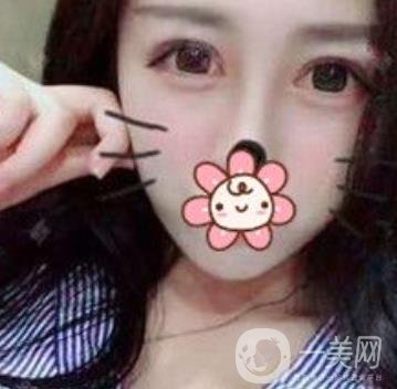 秦皇島人民醫(yī)院雙眼皮怎么樣？附整形價(jià)格表及案例圖