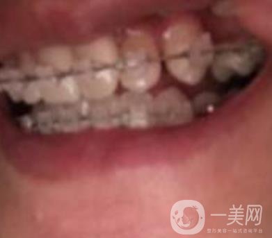 蘭山區(qū)人民醫(yī)院整牙