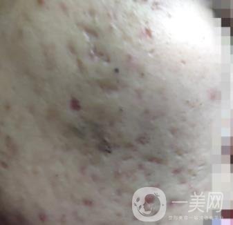 綿陽中心醫(yī)院整形美容科祛痘坑怎么樣？價格表及術后*果分享