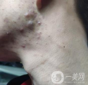 綿陽中心醫(yī)院整形美容科祛痘坑怎么樣？價格表及術后*果分享