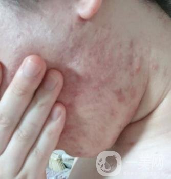 綿陽中心醫(yī)院整形美容科祛痘坑怎么樣？價格表及術后*果分享