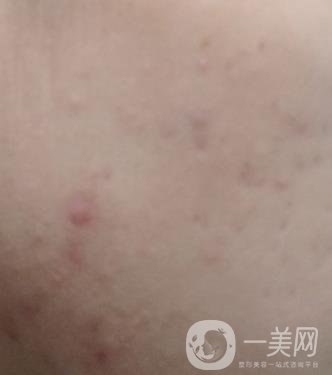 綿陽中心醫(yī)院整形美容科祛痘坑怎么樣？價格表及術后*果分享