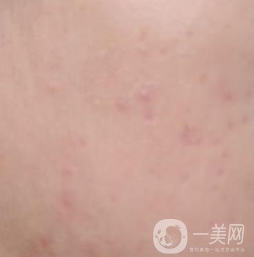 綿陽中心醫(yī)院整形美容科祛痘坑怎么樣？價格表及術后*果分享