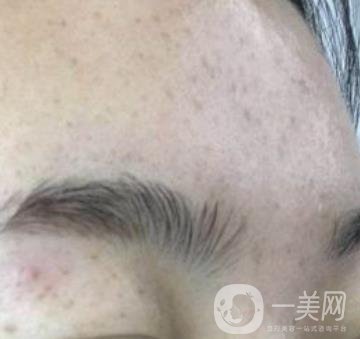 南京省中醫(yī)院整形美容科祛黃褐斑多少錢(qián)？?jī)r(jià)格表及案例詳情一覽