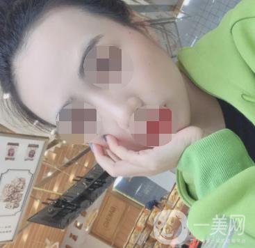 南京省中醫(yī)院整形美容科祛黃褐斑多少錢(qián)？?jī)r(jià)格表及案例詳情一覽